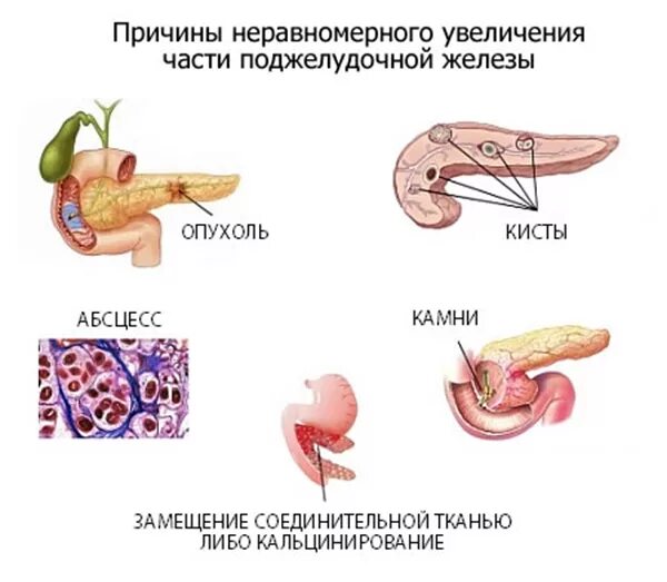 Увеличение поджелудочной железы у взрослых