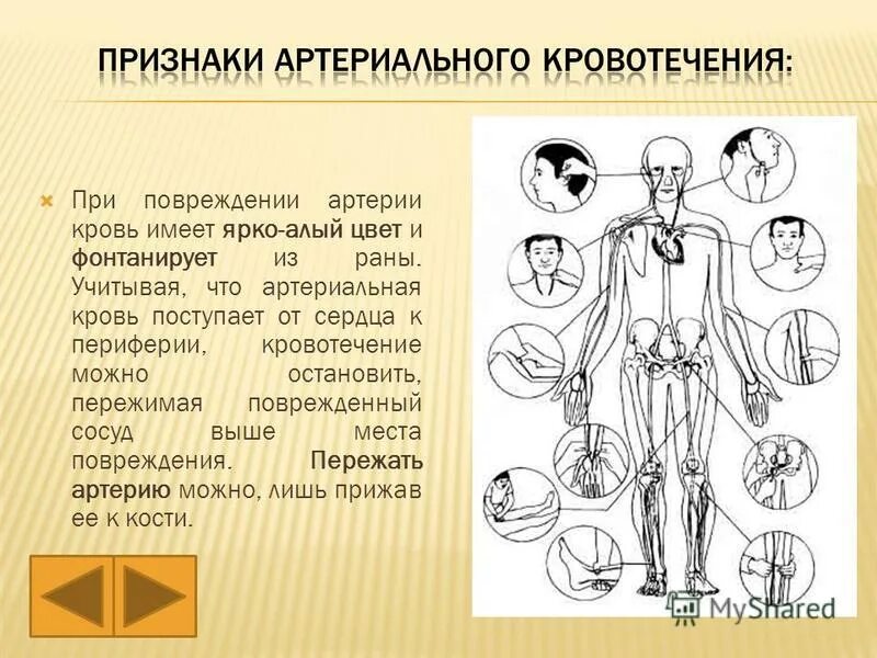 Артериальное кровотечение возникает. Помощь при повреждении артерии. Артериальное кровотечение. Бедренное кровотечение пмп. Артериальное кровотечение первая помощь.