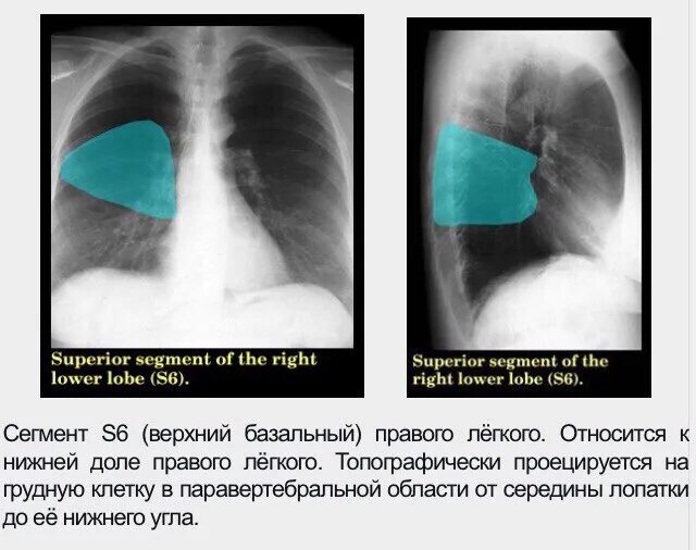 С 6 левого легкого. 6, 10 Сегмент правого легкого. S3 s6 правого легкого. 6 Сегмент правого легкого на рентгенограмме. Сегмент s7 правого легкого.
