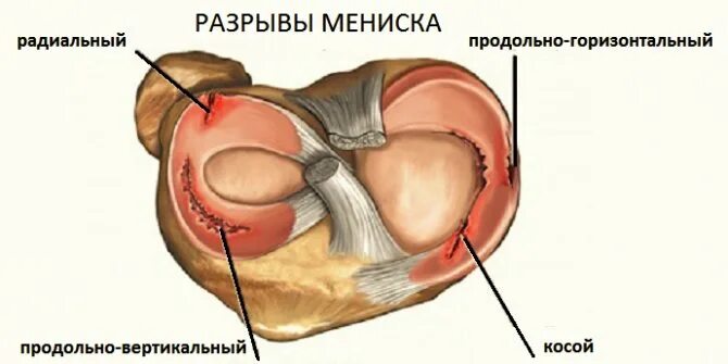 Повреждение латерального мениска 3. Продольный горизонтальный разрыв мениска. повреждение медиального мениска 3 степени. задний рог мениска коленного сустава.