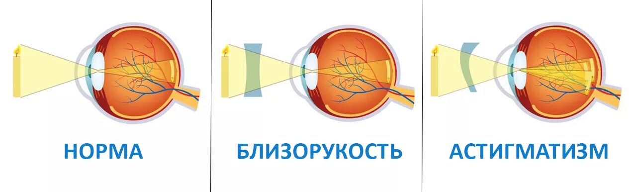 Как выглядит глаз при астигматизме Астигматизм(зрительное помутнение) Mirrored sunglasses, Sunglasses, Glasses