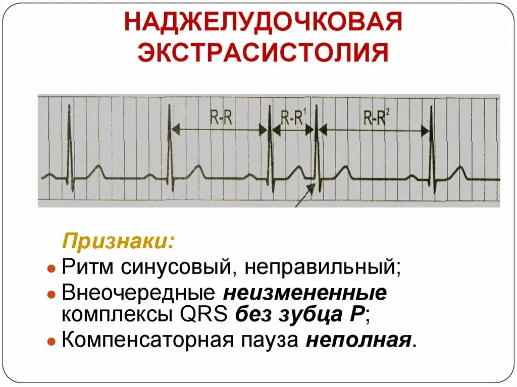 Наджелудочковая экстрасистола на ЭКГ. Наджелудочковые экстрасистолы на ЭКГ. Наджелудочковая экстрасистолия на ЭКГ. Аберрантные экстрасистолы на ЭКГ. Экстрасистолы у женщин