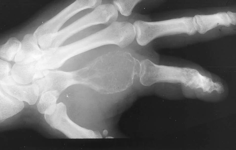 костяной нарост на суставе. костные наросты на суставах что это такое. энхондрома фаланги рентген. узелки гебердена рентген. дерматомиозит кальциноз.