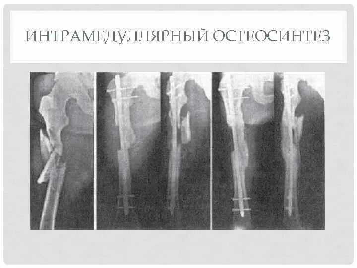 Оскольчатый перелом со смещением. Интрамедуллярный остеосинтез бедренной. интрамедуллярного остеосинтеза бедренной кости. интрамедуллярный остеосинтез тазобедренного сустава. оскольчатый перелом тазобедренного сустава.