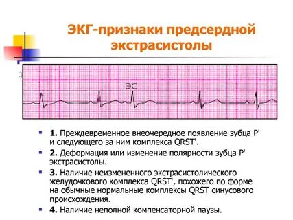 Экг признаки экстрасистолии