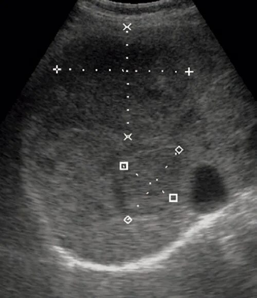 Кавернозная гемангиома печени на УЗИ. УЗИ картина кавернозной гемангиомы печени. Кавкрнозные гемангмомы печень УЗИ. Очаговые гемангиомы печени