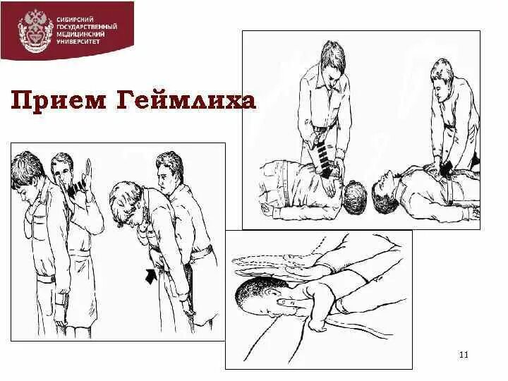Геймлиха самопомощь. Прием геймлиха аккредитация. Приём геймлиха алгоритм. Прием геймлиха в сознании. Прием геймлиха аккредитация.