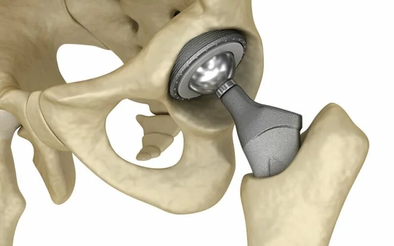 Операция по замене тазобедренного как происходит. Эндопротез Зиммер тазобедренного сустава. Smith nephew эндопротез тазобедренного сустава. Эндопротез шейки бедра Зиммер. Протез Зиммер коленный сустав.