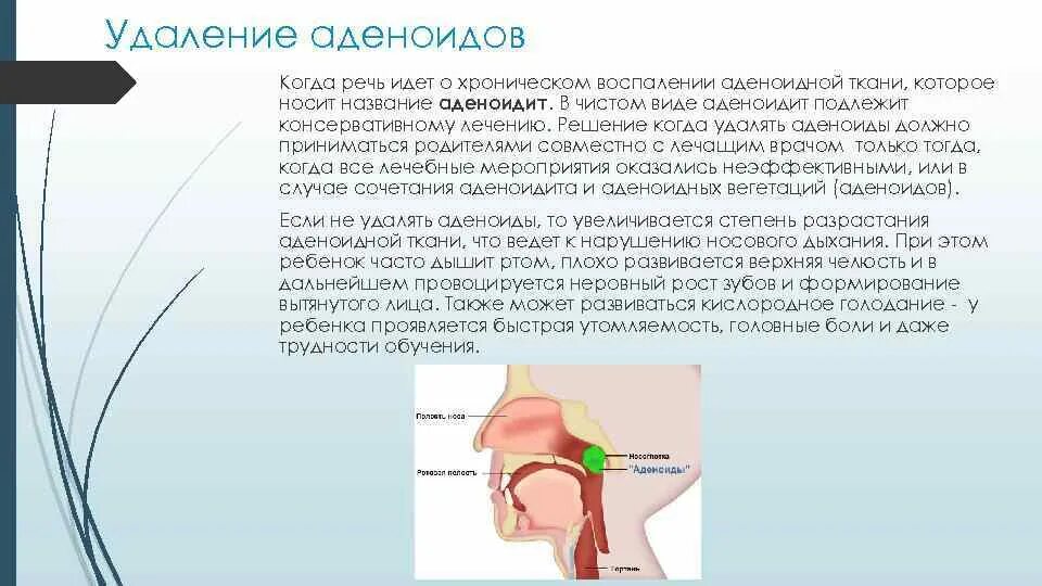 Аденоидный вегетация 3. Операция аденотомия у детей. Аденоиды у детей операция.