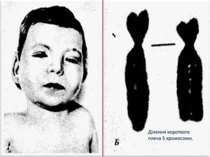 Делеция короткого плеча хромосомы 5