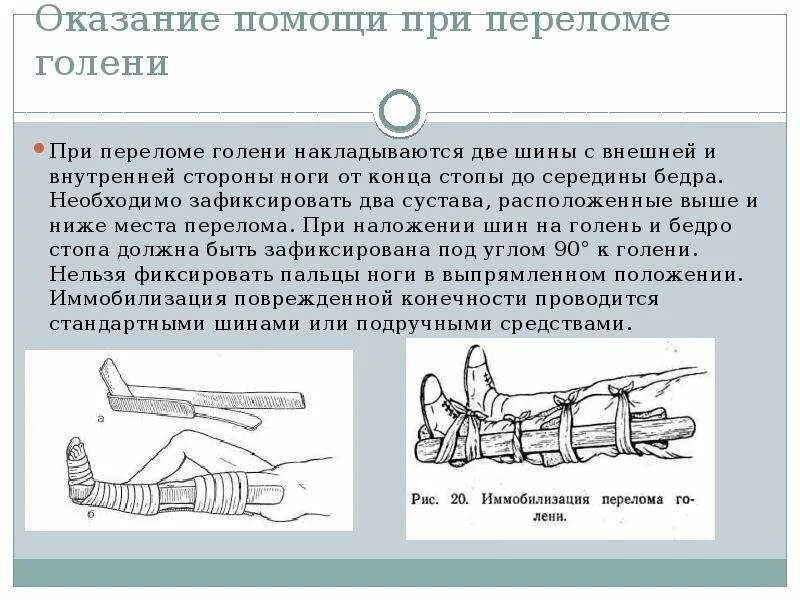 Открытый перелом бедра первая помощь. Наложение шины Крамера при переломе костей голени. Иммобилизация конечности при переломе наложение шины Крамера. Транспортная иммобилизация при переломах костей. Наложение шины при переломе костей голени.