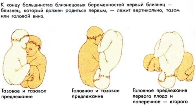 Сколько минут выходит ребенок. Предлежание плодов при многоплодной беременности. Правильное положение плода. Положение двойни поперечное и головное.