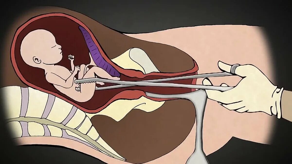 Зачем пришел в род. Хирургический аборт на поздних сроках. Инструментальный аборт. Искусственное прерывание родов.