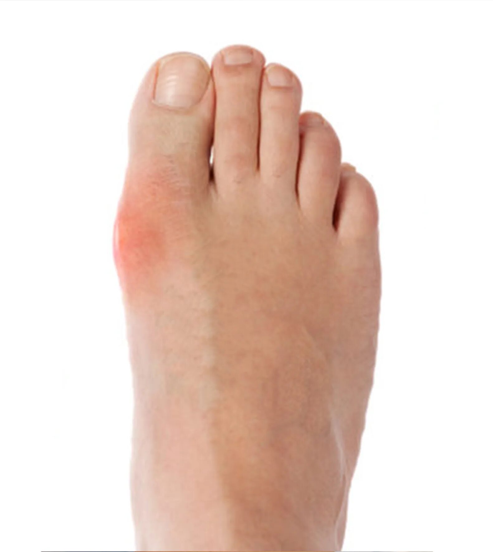 Артрит подагра большого пальца. Подагрический артрит ноги. Подагрический артрит голеностопного сустава симптомы.