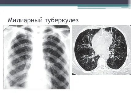 Милиарный туберкулез