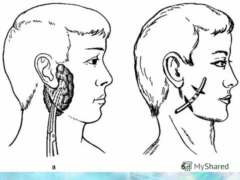 Операции околоушной железы