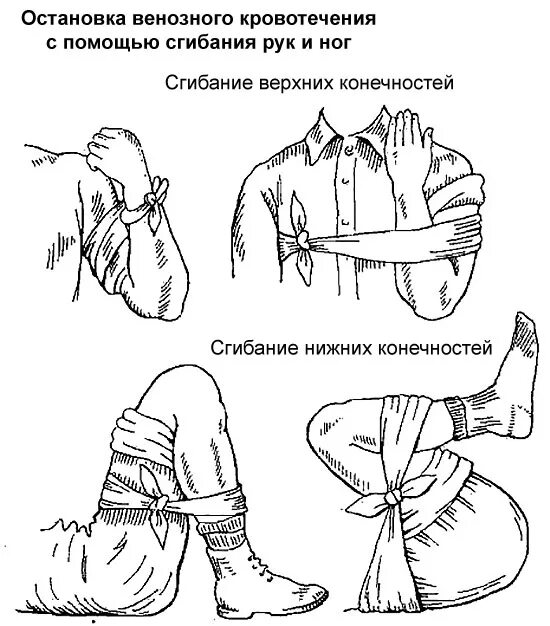 Способы наложения повязок при кровотечении. Методы остановки венозного кровотечения алгоритм. Способы остановки венозного кровотечения картинки. Остановка венозного кровотечения алгоритм. Остановка венозного кровотечения предплечья.