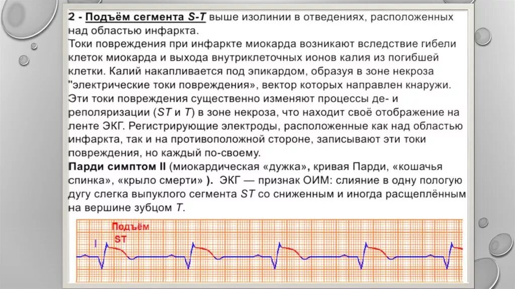 Экг подъем. Подъем сегмента St на ЭКГ. Сегмент St на ЭКГ выше изолинии. Подъем сегмента St на ЭКГ при инфаркте. Подъем изолинии на ЭКГ.