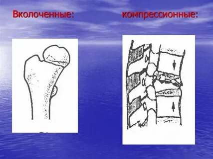 Вколоченный перелом