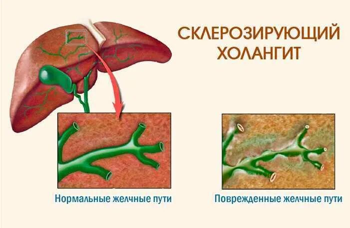 Болезни желчного протока. Хронический склерозирующий холангит. Патогенез первичного склерозирующего холангита. Первичный билиарный холангит.