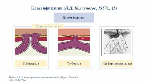 Кишечные свищи