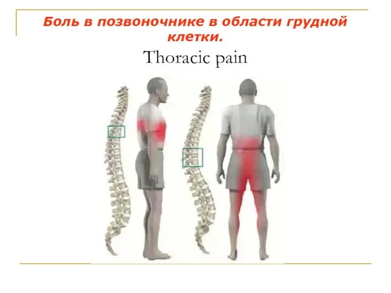 Грудные позвонки боль. Боль в позвоночнике. Боли при остеохондрозе грудного отдела позвоночника. Остеохондроз грудной клетки позвоночника. Локализация боли при остеохондрозе грудного отдела.