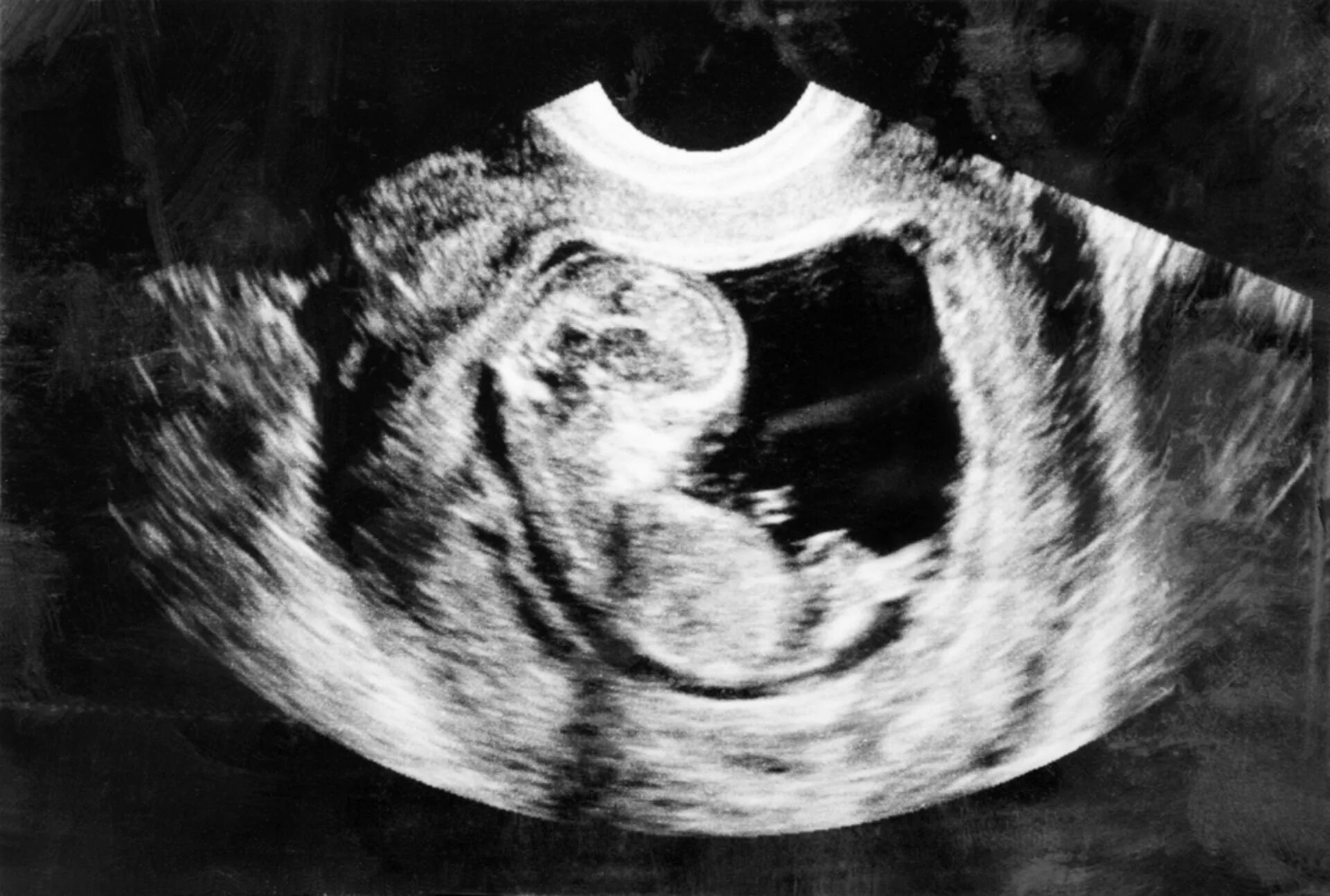 Беременность 5 недель можно. Эмбрион 5 месяцев беременности УЗИ. УЗИ 3 месяца беременности. Эмбрион на 2 месяце беременности УЗИ. УЗИ плода на 3 месяце беременности.