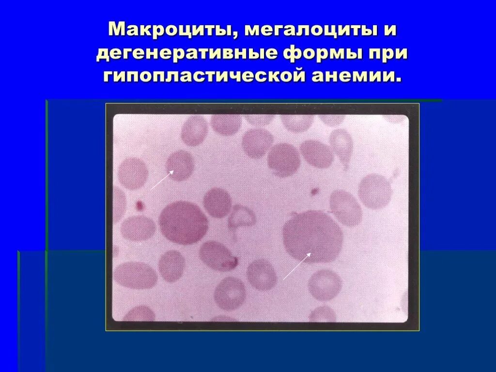 Пониженные макроциты. Апластическая анемия эритроциты форма. Макроциты и микроциты. Картина крови при гипопластической анемии. Морфологическая картина крови при гипопластической анемии.