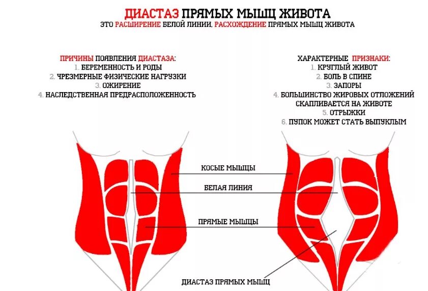 Прямая мышца живота у женщин. Диастаз прямой мышцы беременность. Диастаз мышц живота 2 степени. Норма расхождения прямых мышц живота. Диастаз мышц передней брюшной стенки.