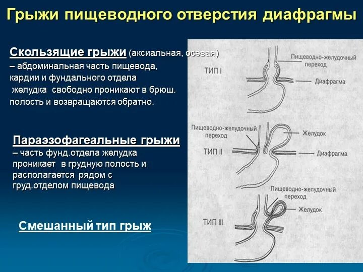 Грыжа пищевода признаки симптомы. Грыжа пищеводного отверстия диафрагмы рентген классификация. 4 Типы грыж пищеводного отверстия диафрагмы. Диафрагмальная грыжа пищеводного отверстия диафрагмы. Скользящие грыжи пищеводного отверстия диафрагмы рентген.