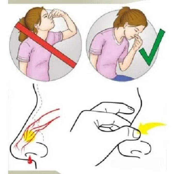Как Остановить кровь из носа. Вызывание кровотечения из носа. Как Остановить кровь из носа у ребенка. Как сделать чтобы пошла кровь из носа
