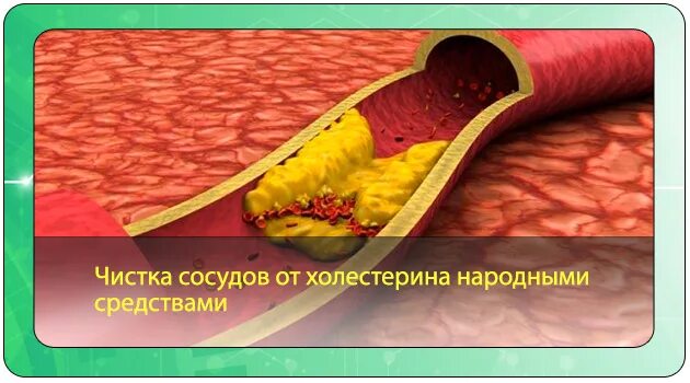 Что чистит сосуды от холестериновых. Очищение сосудов от холестерина. Препарат для очистки сосудов от холестерина. Атеросклероз чистка сосудов.