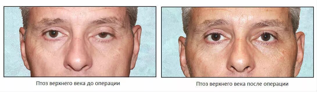 Птоз ( опущение верхнего века. Птоз верхнего века после операции. Птоз верхнего века одного глаза. Птоз без операции