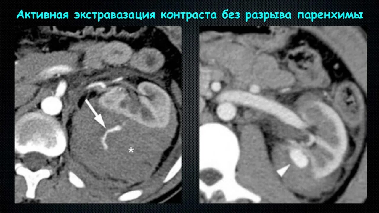 Что такое экстравазация. Экстравазация контрастного вещества. экстравазация контрастного вещества при кт. экстравазация опухоли.