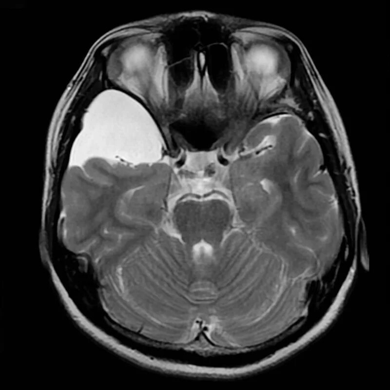 Арахноидальная киста височной доли мрт. Арахноидальная киста сильвиевой щели мрт. Арахноидальная киста височной доли кт. Арахноидальная киста Galassi. Изменение ликворокистозного характера