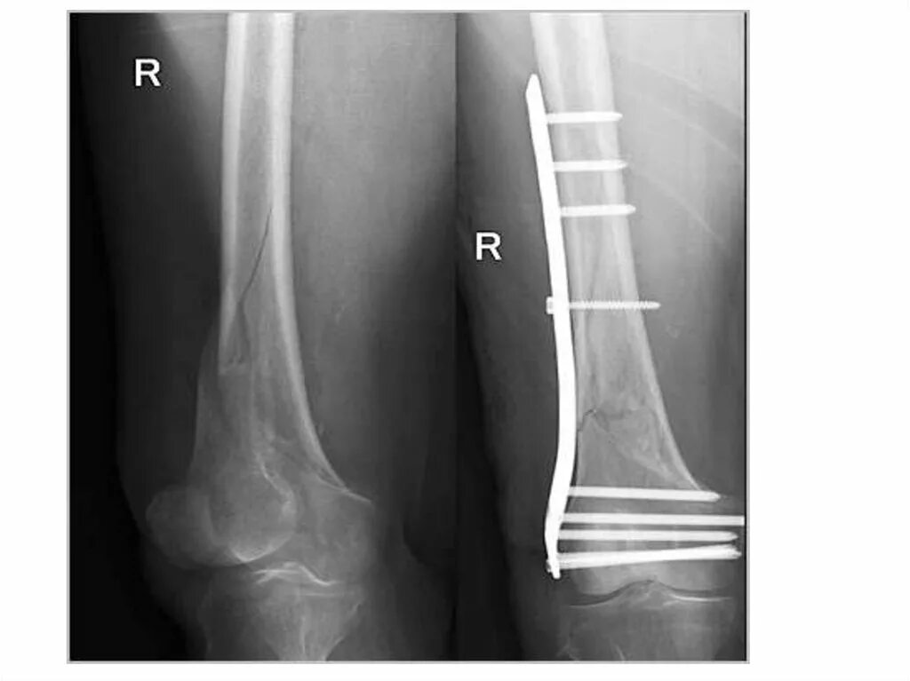 Сколько срастается трещина. Остеосинтез перелома плечевой кости. Перелом диафиза бедренной кости операция. Остеосинтез диафиза плечевой кости пластиной. Остеосинтез диафиза большеберцовой кости.