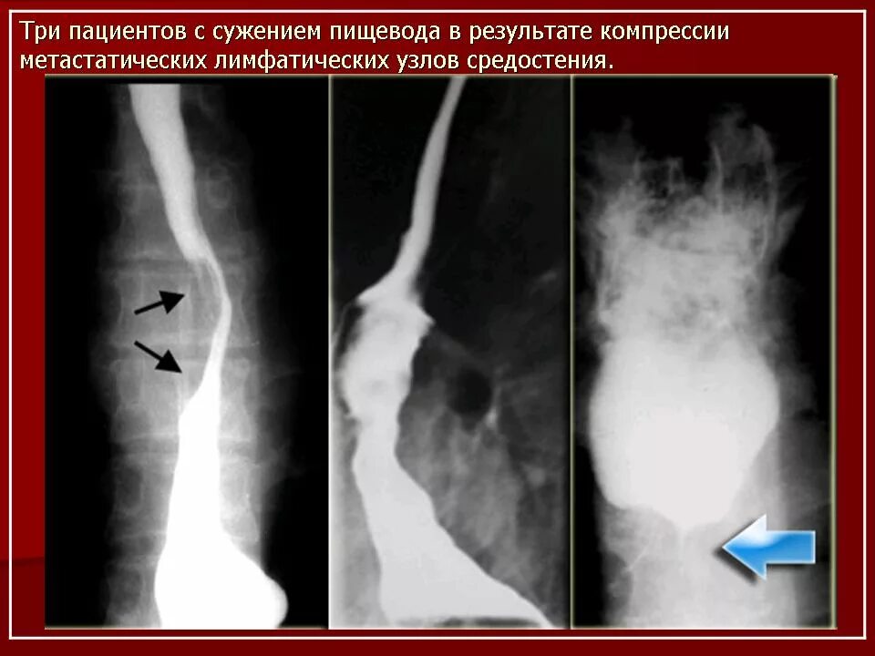 Как восстановить пищевод