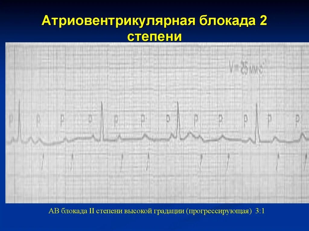 Полная АВ блокада 2 степени. Что такое АВ блокада сердца 2 степени?. Блокада 2 степени сердце что это. АВ блокада 2 степени высоких градаций.