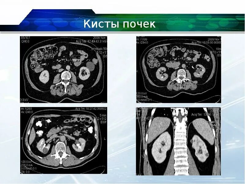 Сегменты правой почки. Гиперденсная киста почки кт. экстраренальная киста почки кт. многокамерная киста почки на кт.