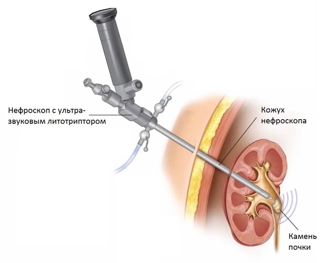 Удаление стенда из мочеточника. Контактная литотрипсия камней почек лазером. Контактная литотрипсия камней в почках. Чрескожная перкутанная нефролитотрипсия. Чрескожная литотрипсия камней в почках.