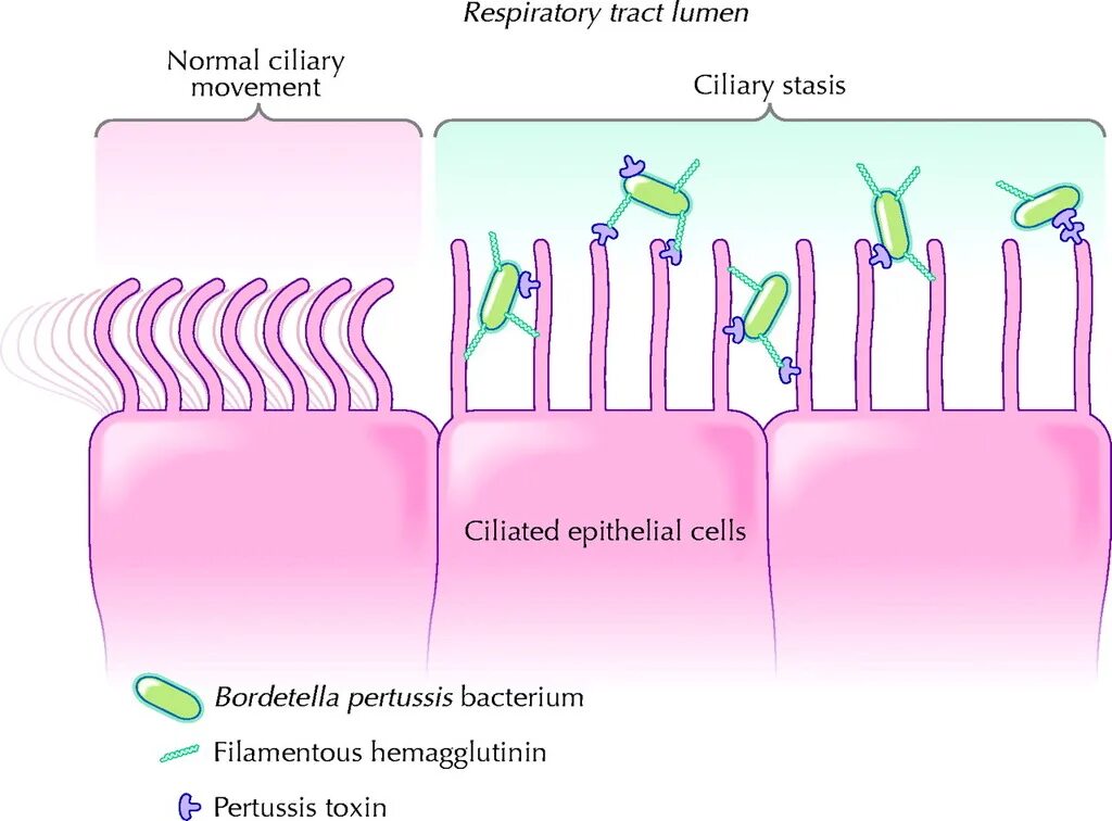 Pertussis коклюш. Bordetella pertussis патогенез. Возбудитель коклюша Bordetella pertussis. Патогенез.бордетеллы коклюша. Патогенез коклюша схема.