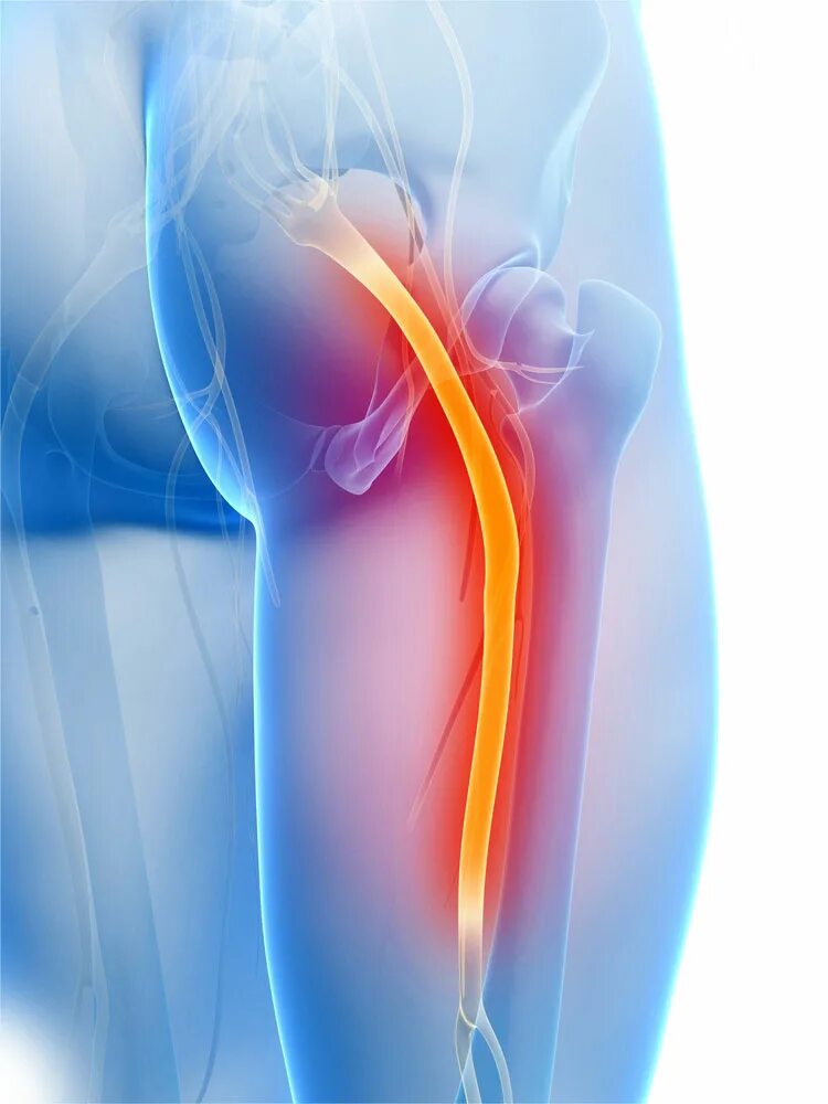 Блокада при защемлении седалищного нерва. Седалищный нерв (sciatic nerve)? 011. Блокада при ишиасе седалищного нерва. Доктор Мясников , ишиас седалищного нерва.