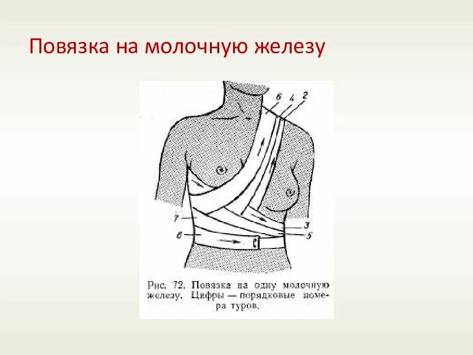 Повязка на молочные железы алгоритм. Наложите повязку на молочную железу. Десмургия повязка на молочную железу. Поддерживающая повязка на молочную железу алгоритм. 3. Наложите повязку на молочную железу..