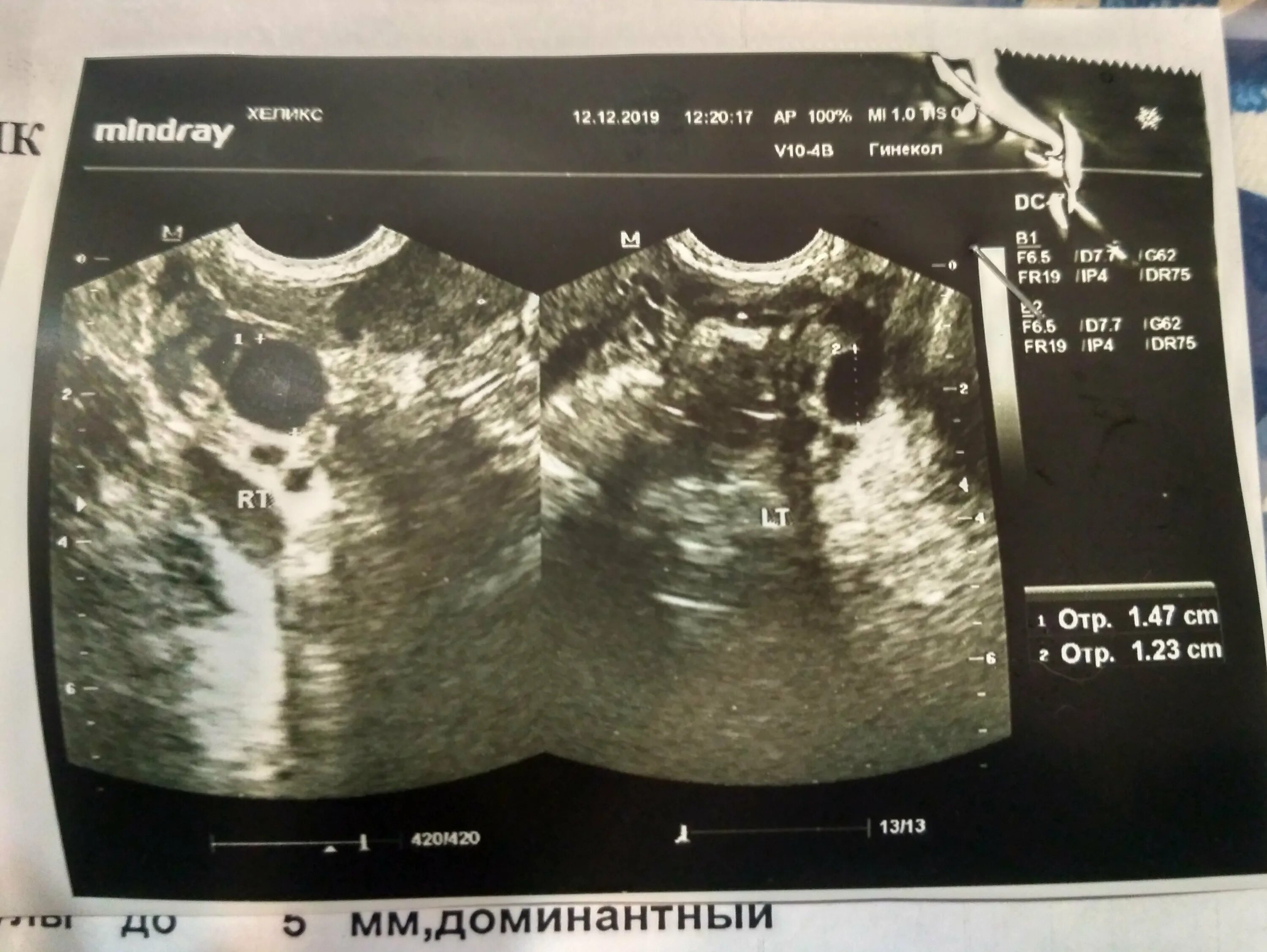 Эндометрия соответствует 2 фазе. Толщина эндометрия 11мм. эндометрий 7 мм во второй фазе. фолликулометрия.