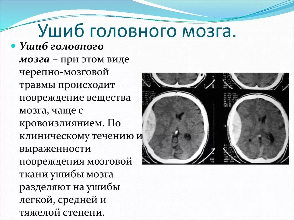 Повреждение вещества головного мозга. Закрытые травмы головного мозга. При ушибе головного мозга. Гематома черепно мозговой травме