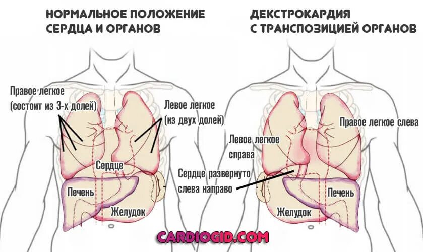 Колет там. Расположение сердца у человека. Расположение сердца справа. Сердце справа декстрокардия.