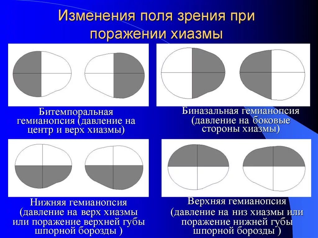 Выпадение полей зрения неврология. Левосторонняя гомонимная гемианопсия очаг поражения. Гетеронимная гемианопсия. Битемпоральная гемианопсия. Монимен