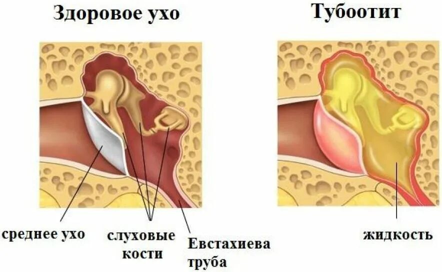 Заложенность уха тубоотит. Туботимпальный Гнойный отит. Евстахиит острый и хронический. Хронический Гнойный средний отит клиника. Евстахиит барабанная перепонка.