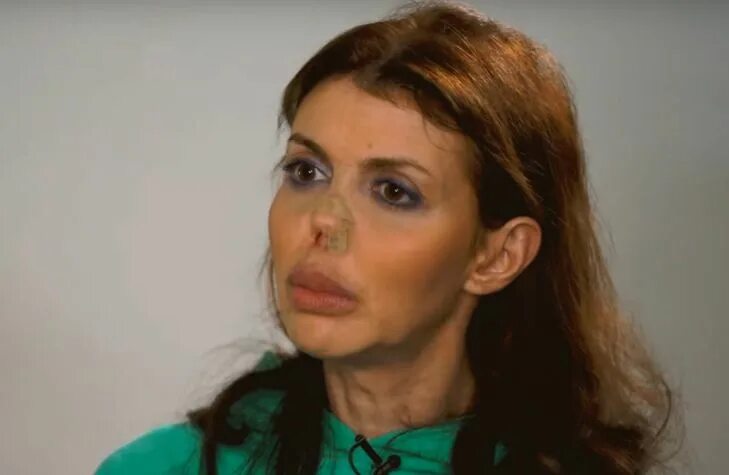 новый нос алисы казьминой