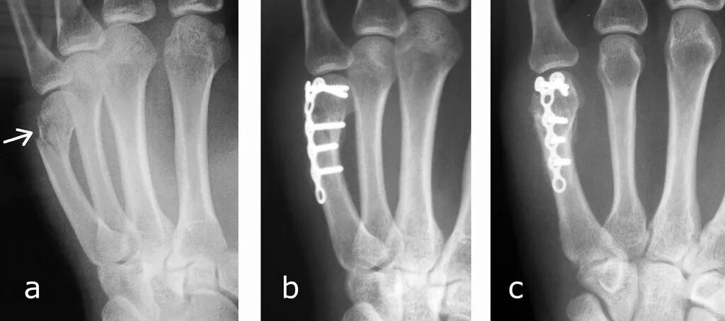 Закрытый субкапитальный перелом 1 пястной кости. Перелом пятого пальца. Боксерский перелом 3 пястной кости. Перелом 5-пястной кости правой руки. Перелом пятого пальца.